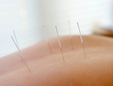Western acupuncture